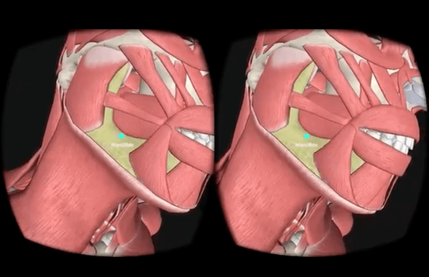 Thesis project image showing mandible therapy device